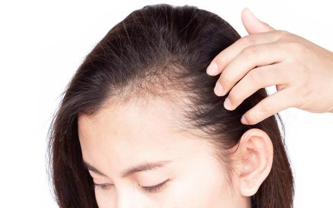 Candida is nearly certainly not going to cause hair loss by itself. It is more likely that an antifungal drug you are taking is responsible for the loss of hair--than Candida being the cause.