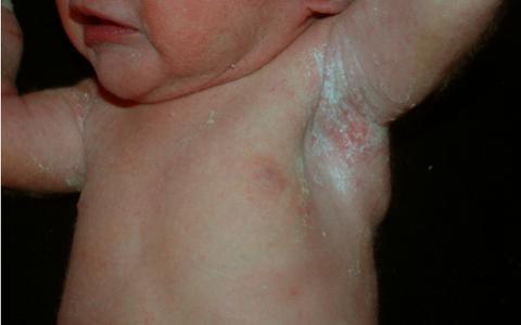 Pictured here is a baby that had a Candida albicans infection from birth. The white skin lesions of Candida are visible on the baby’s skin. If you have a buttocks yeast infection, it may look somwhat similar to the infected skin in this picture. Image Source: Torres-Alvarez, Bertha, et al. Dermatology Online Journal. 