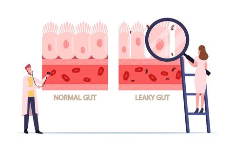 Leaky gut syndrome can be caused, or aggravated by, Candida overgrowth in the gut. Candida can literally drill into tissue surfaces; this penetration, can lead to a weakness of that tissue.