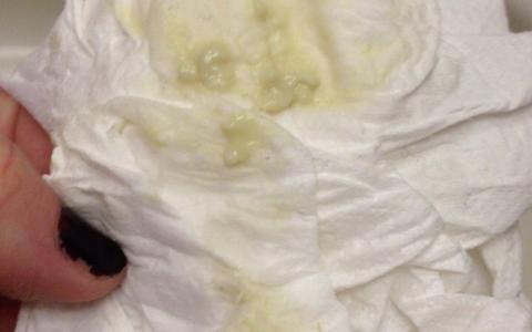 Yeast infections can cause thick white discharge and itching in many instances. This picture may be from yeast infection discharge; yet, without a laboratory culture, you can only surmise.