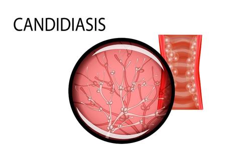 Yeast infection sores are a real symptom caused by Candida