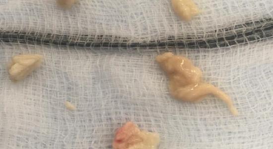 Pictured here are fungus balls (made of Candida albicans, which was determined by a laboratory culture test) found in the bladder of an 80 year old man with diabetes. These balls were blocking urinary flow. Image source: Abuelnaga, Mahmoud, et al. Case Reports in Urology [2019].
