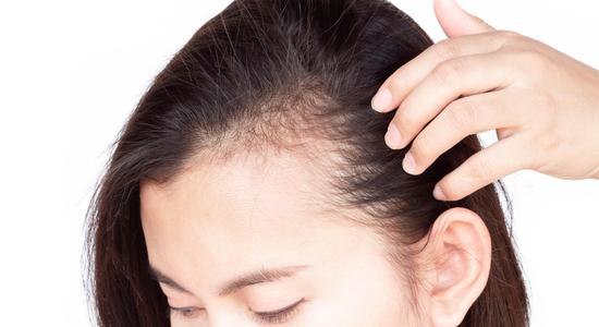 Candida is nearly certainly not going to cause hair loss by itself. It is more likely that an antifungal drug you are taking is responsible for the loss of hair--than Candida being the cause.