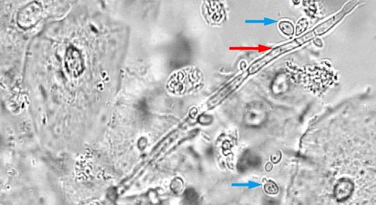Pictured here is the yeast Candida albicans. The red arrow in the picture points to a hyphal (germ tube) growth. The blue arrows indicate single cells of the yeast that have not grown into hyphal structures.