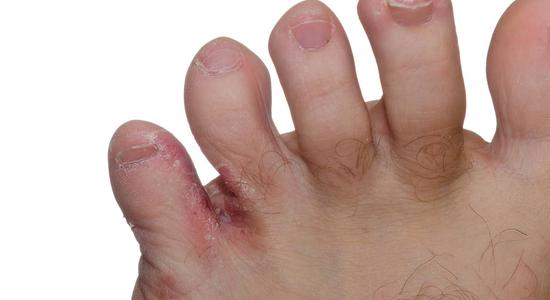 A picture of the fungal infection athelete’s foot (Tinea pedis).