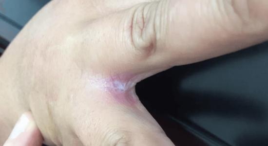Pictured here is a yeast infection between the fingers. This condition is technically referred to as erosio interdigitalis blastomycetica (EIB). The lesions of EIB have very characteristic features. Image Source: Schlager, et al.; Dermatology Online Journal (2018)
