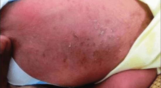 Pictured here are bumps on the skin caused by a yeast infection. Occasionally, mothers with vaginal yeast infections,  will find the infection has spread this treatable condition to her child in the womb. Source: https://doi.org/10.4103/2229-5178.144531