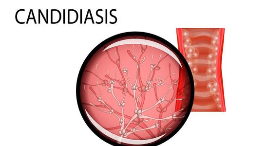 Yeast infection sores are a real symptom caused by Candida
