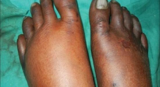 This picture does not show a yeast infection, but does show edema. Edema is the medical term for abnormal swelling. When a body part is injured it can become inflamed and experience edema. Source: https://doi.org/10.4103%2F2278-330X.105858
