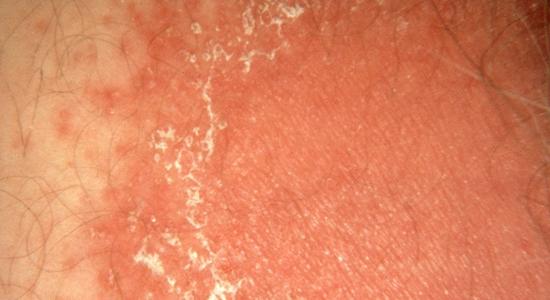 Pictured here is a skin yeast infection.  This rash has the classic signs of Candida: reddened skin and visible white patches.